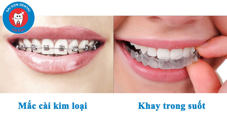 Các phương pháp niềng răng