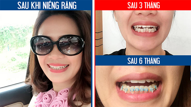 Hình ảnh khách hàng niềng râng