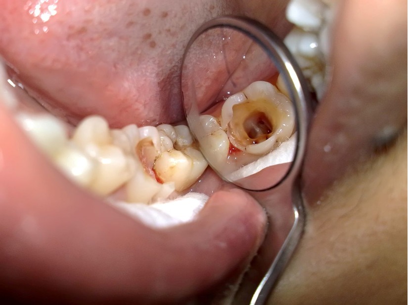 Răng bị viêm tủy