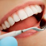 trồng răng sứ mất bao lâu
