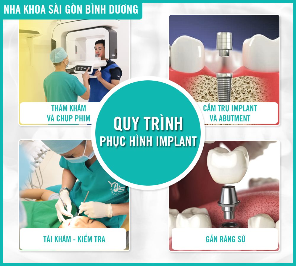 Quy trình 4 bước cắm implant tại nha khoa Sài Gòn