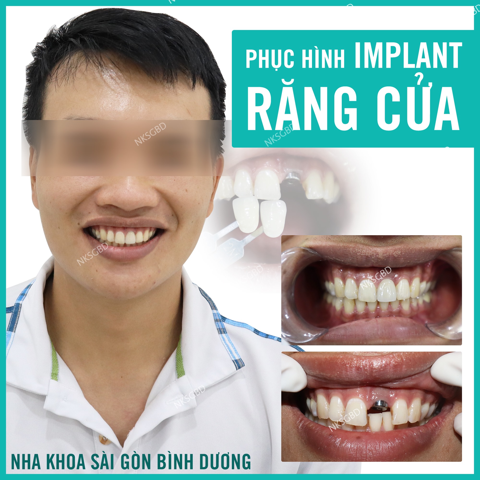 cắm ghép implant tại nha khoa Sài Gòn

