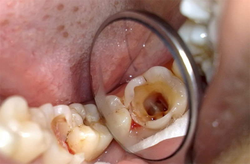Trám răng giúp khắc phục tình trạng răng sâu