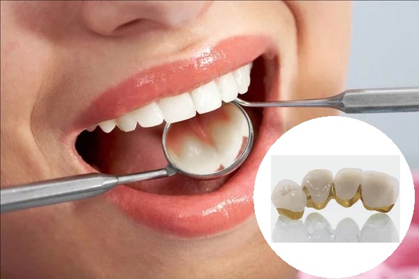 Ưu và nhược điểm của răng sứ kim loại