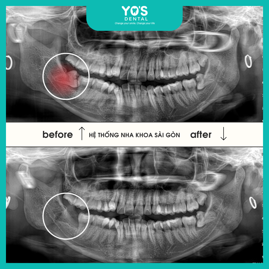 Dịch Vụ Nhổ Răng Khôn Không Đau Tại Nha Khoa Sài Gòn - Yo's Dental