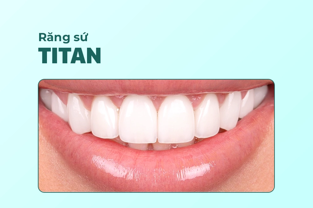 Răng sứ Titan