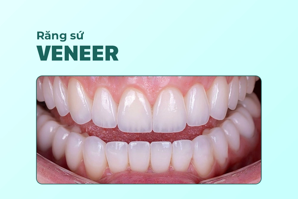 Răng sứ Veneer