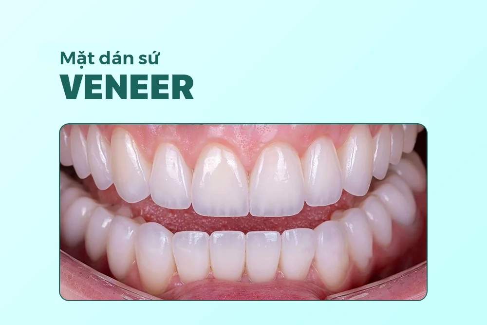 Mặt dán sứ veneer