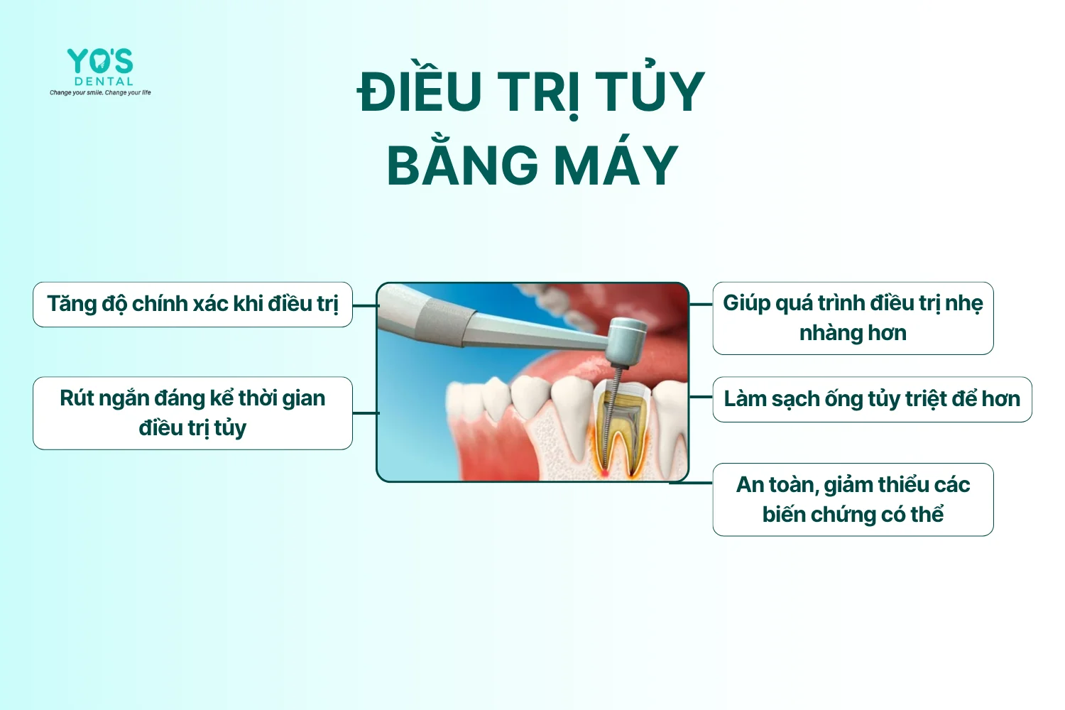 Điều trị tủy - Điều trị lại _ Điều trị bằng máy - 093 - 1