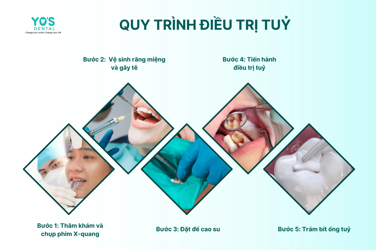 Điều trị tủy - Thông tin dịch vụ chung - 2