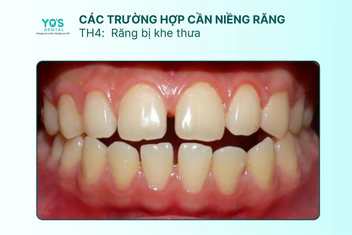 Niềng răng - Thông tin dịch vụ chung (1)