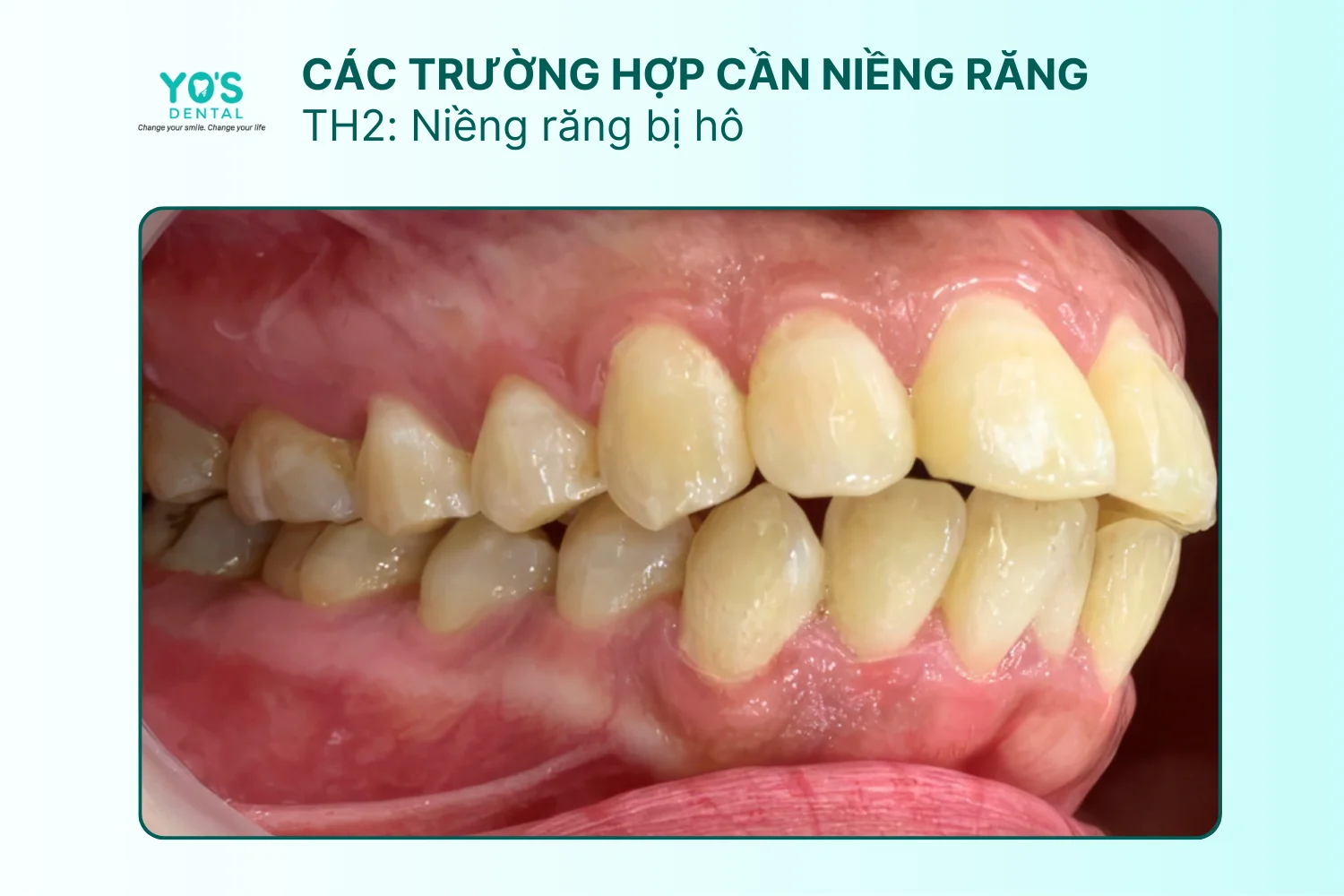 Niềng răng - Thông tin dịch vụ chung (11)