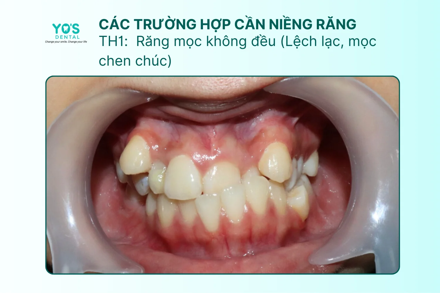 Niềng răng - Thông tin dịch vụ chung (12)