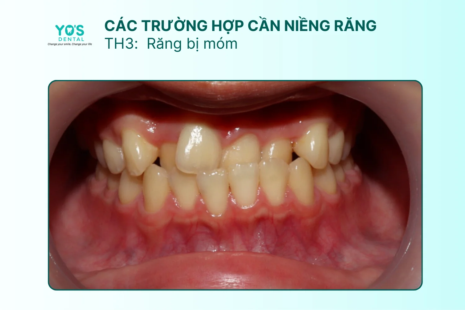Niềng răng - Thông tin dịch vụ chung (3)