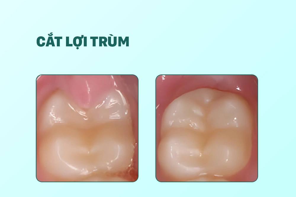 Cắt lợi trùm