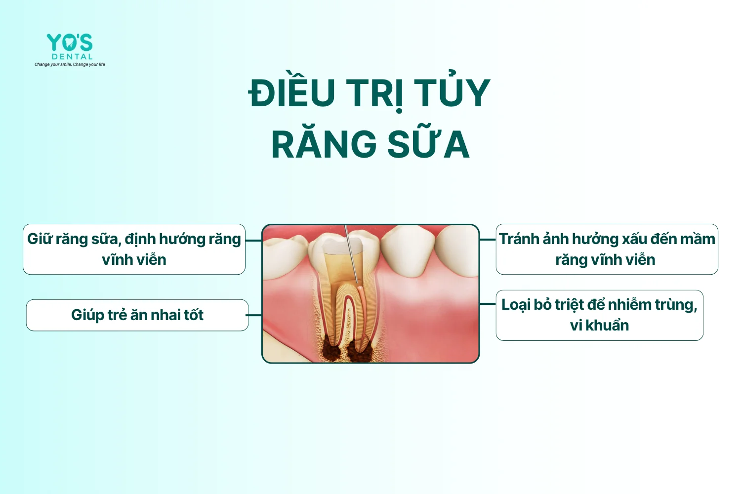 Điều trị tủy - Điều trị tủy (răng sữa) - 094 - 1