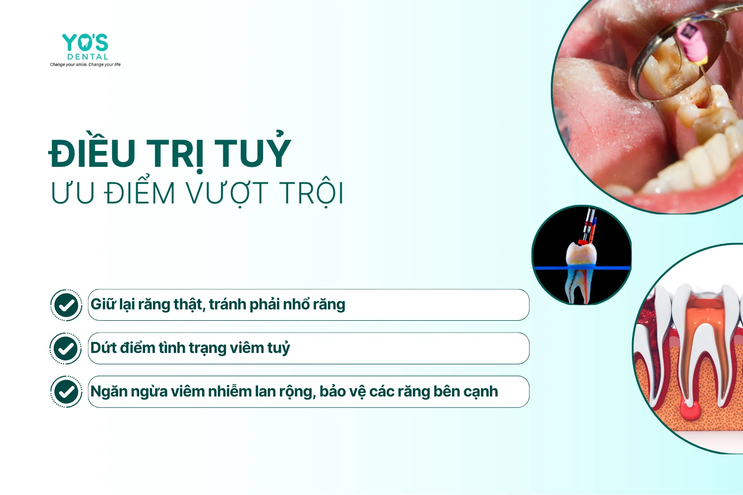 Điều trị tủy - Thông tin dịch vụ chung - 4