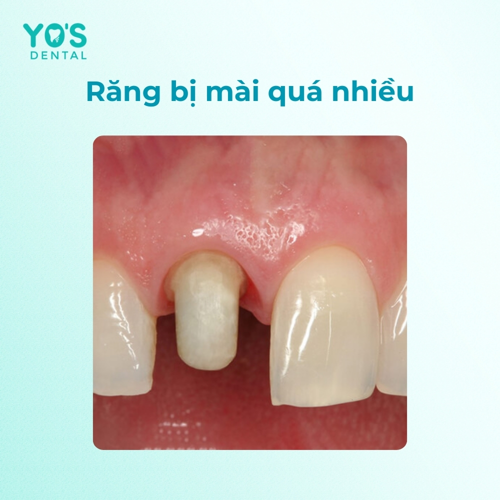 Răng bị mài quá nhiều cũng dễ bị đau khi nhai