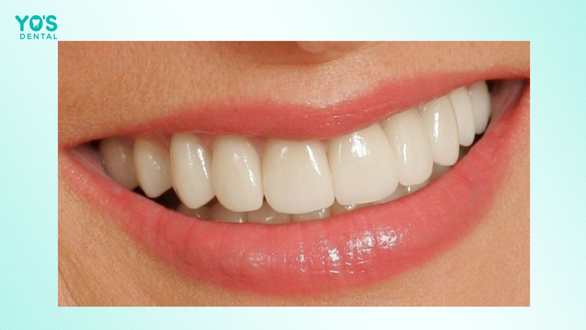 Các câu hỏi thường gặp về ăn uống sau khi bọc răng sứ