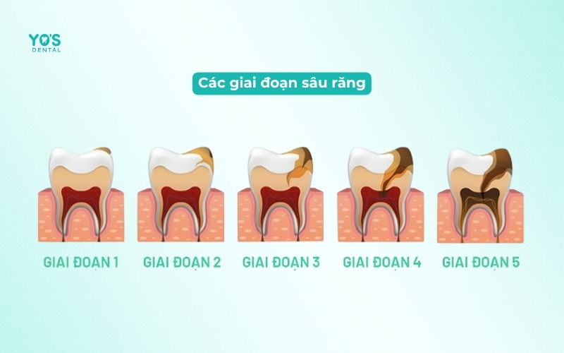 Các giai đoạn sâu răng cần được xử lý trám