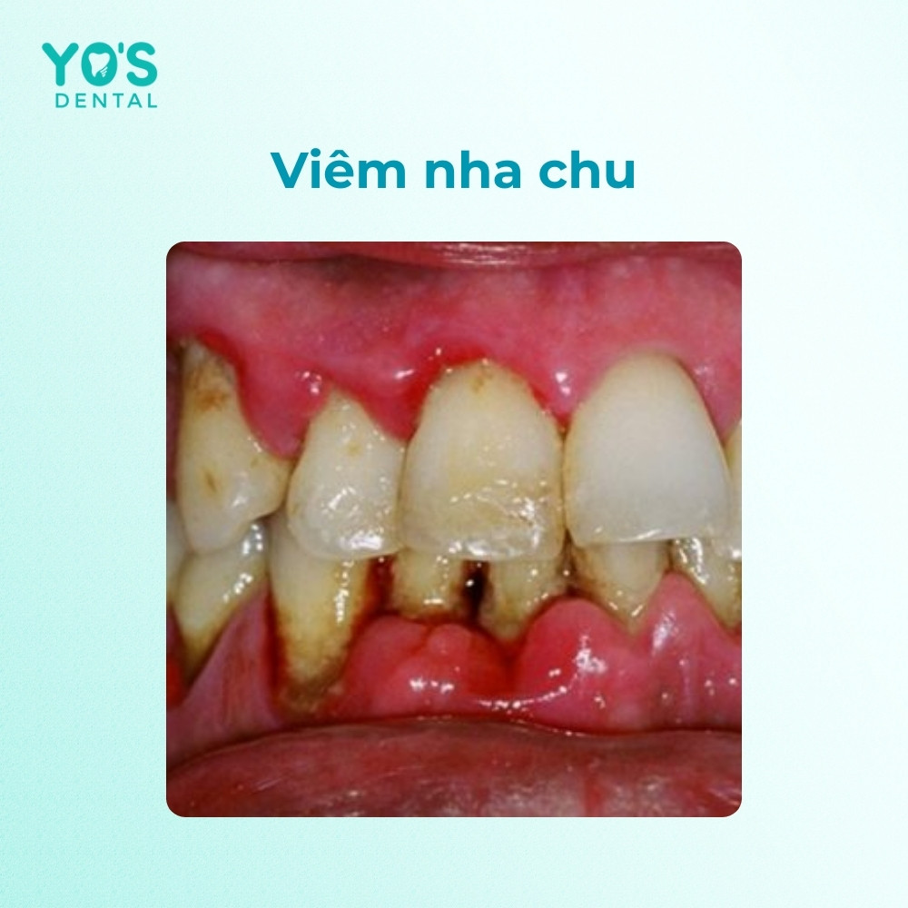 Viêm nha chu là một trong những biến chứng nguy hiểm nhất của cao răng đen