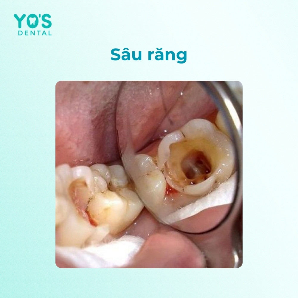 Sâu răng là một trong những nguyên nhân hình thành cao răng đen