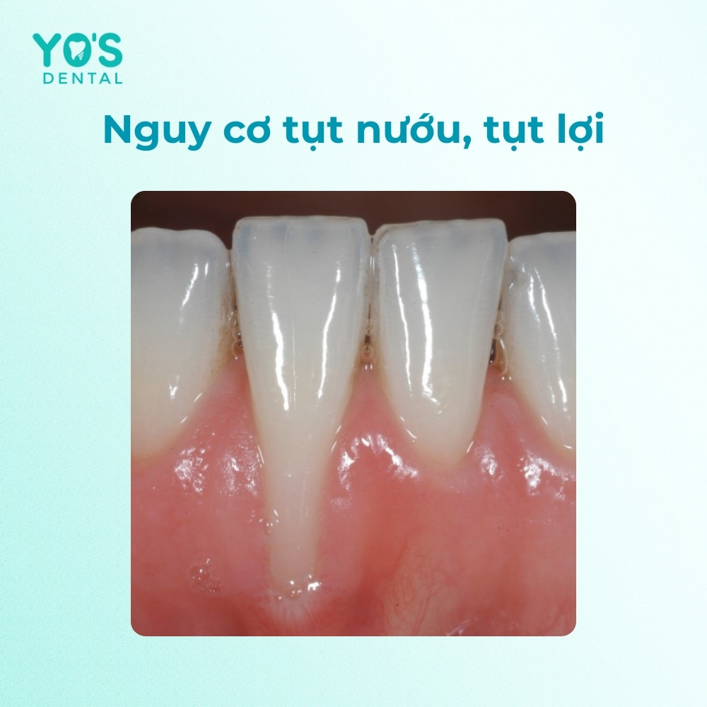 Khi bị cao răng đen, bạn có nguy cơ tụt nướu, tụt lợi