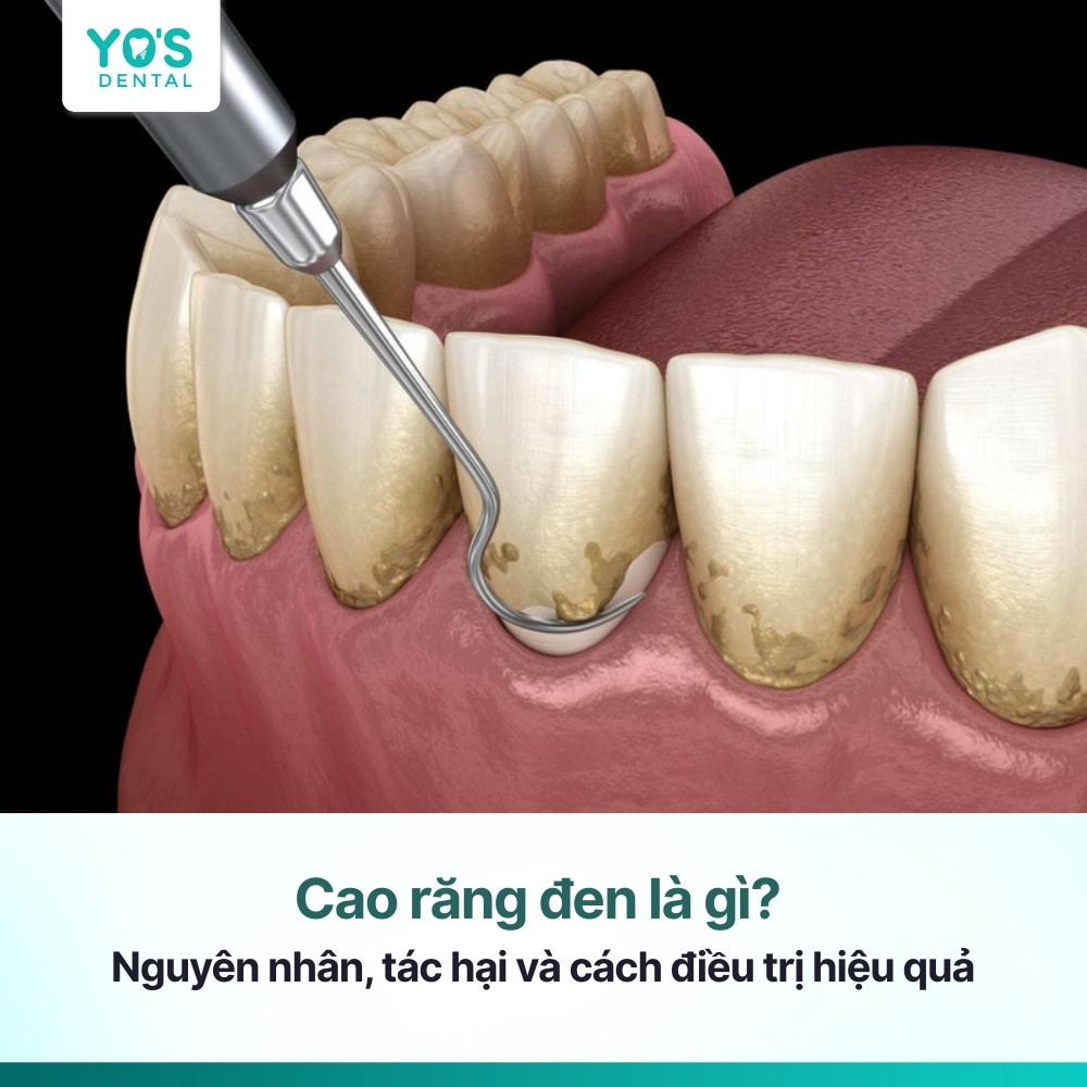 Cao răng đen là gì? Nguyên nhân, tác hại và cách điều trị hiệu quả