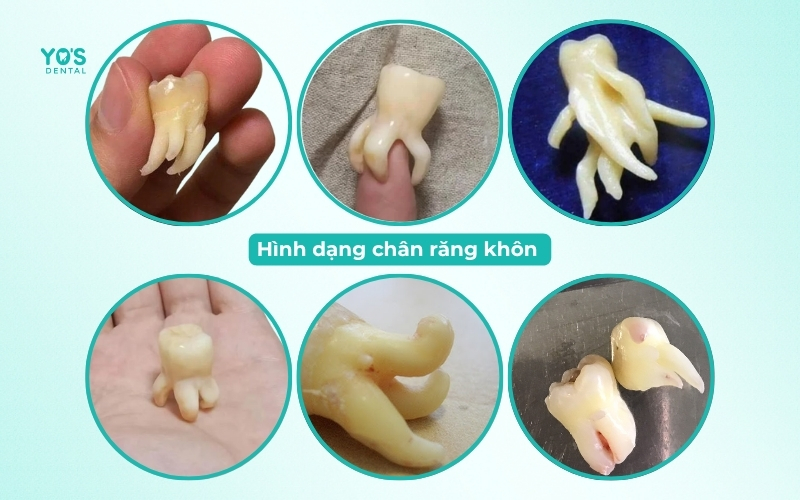 Hình dạng chân răng khôn cực kì phong phú
