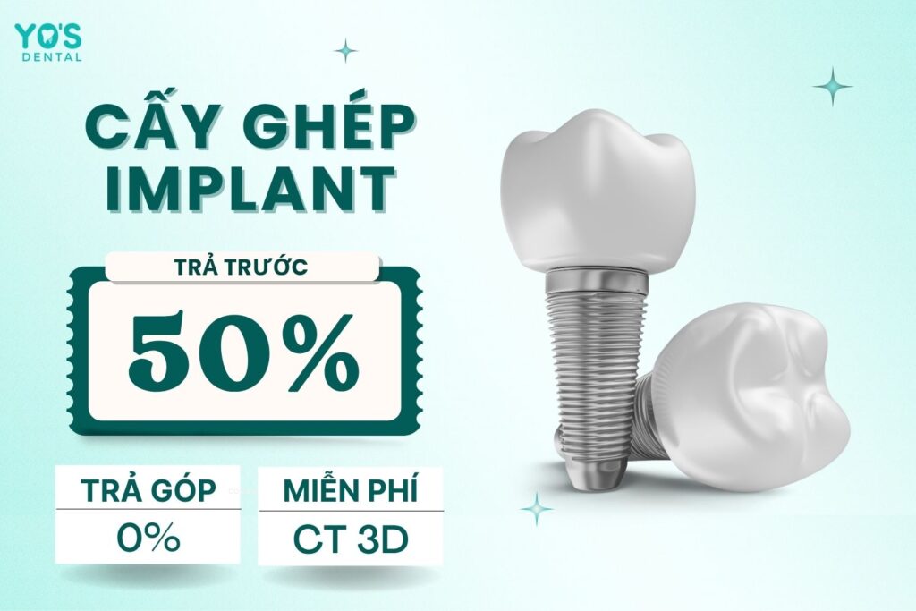 Chỉ trong tháng 7: Cấy ghép Implant - Ưu đãi trả trước 50% lột xác nụ cười 