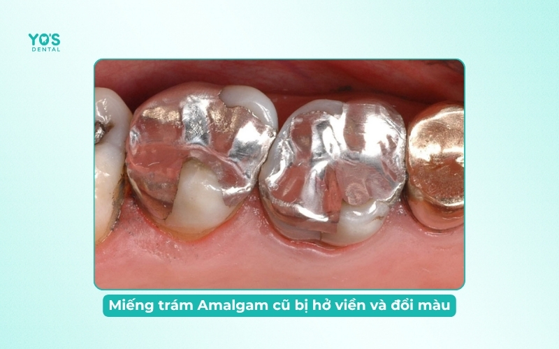 Một miếng trám Amalgam cũ bị hở viền và đổi màu