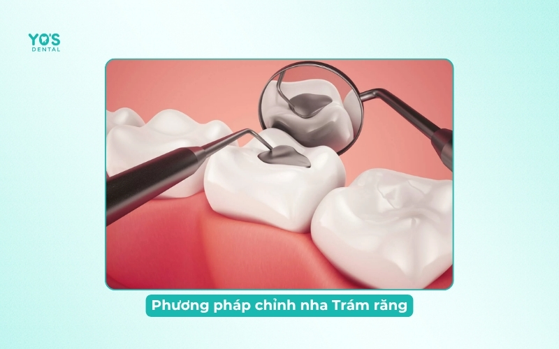 Phương pháp chỉnh nha Trám răng