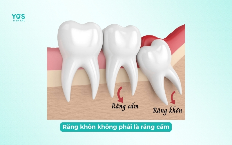 Răng khôn không phải là răng cấm