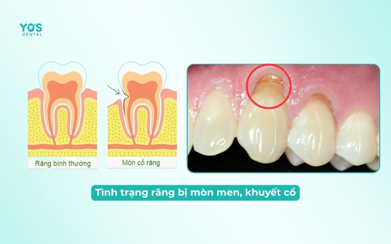 Tình trạng răng bị mòn men, khuyết cổ chân răng