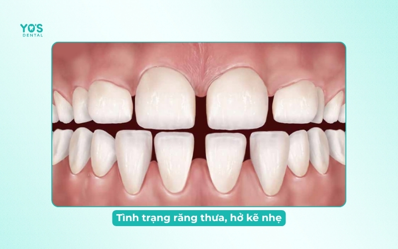 Tình trạng răng thưa, hở kẽ nhẹ