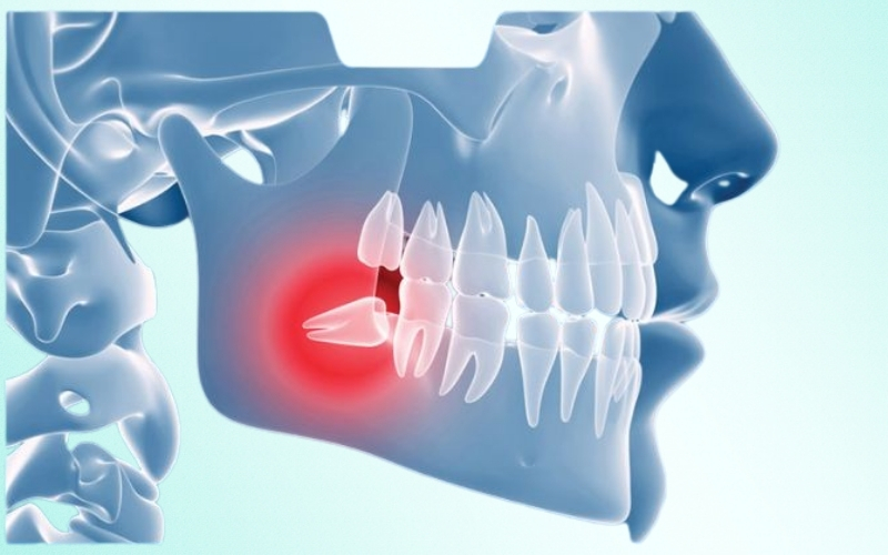 Vị trí răng số 8 (răng khôn) so với các răng khác