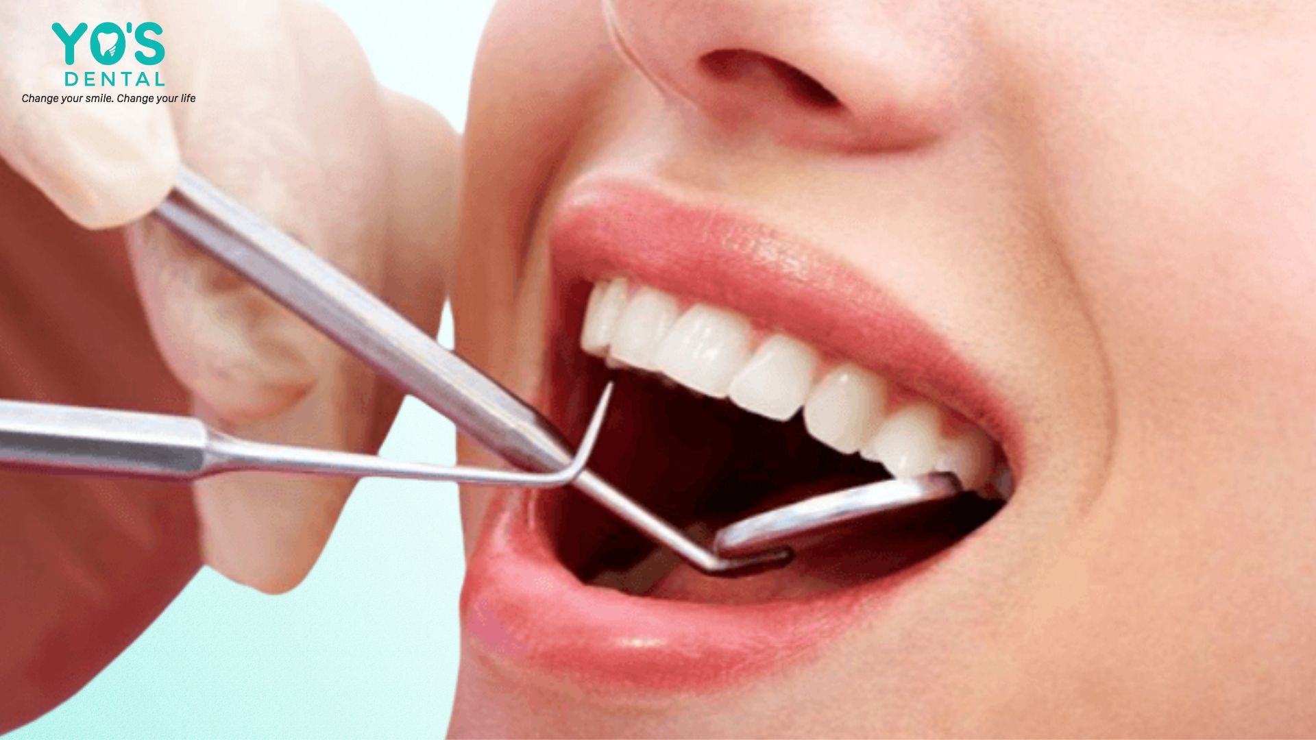 Thăm khám tại nha khoa để xác định chính xác nguyên nhân gây hôi miệng