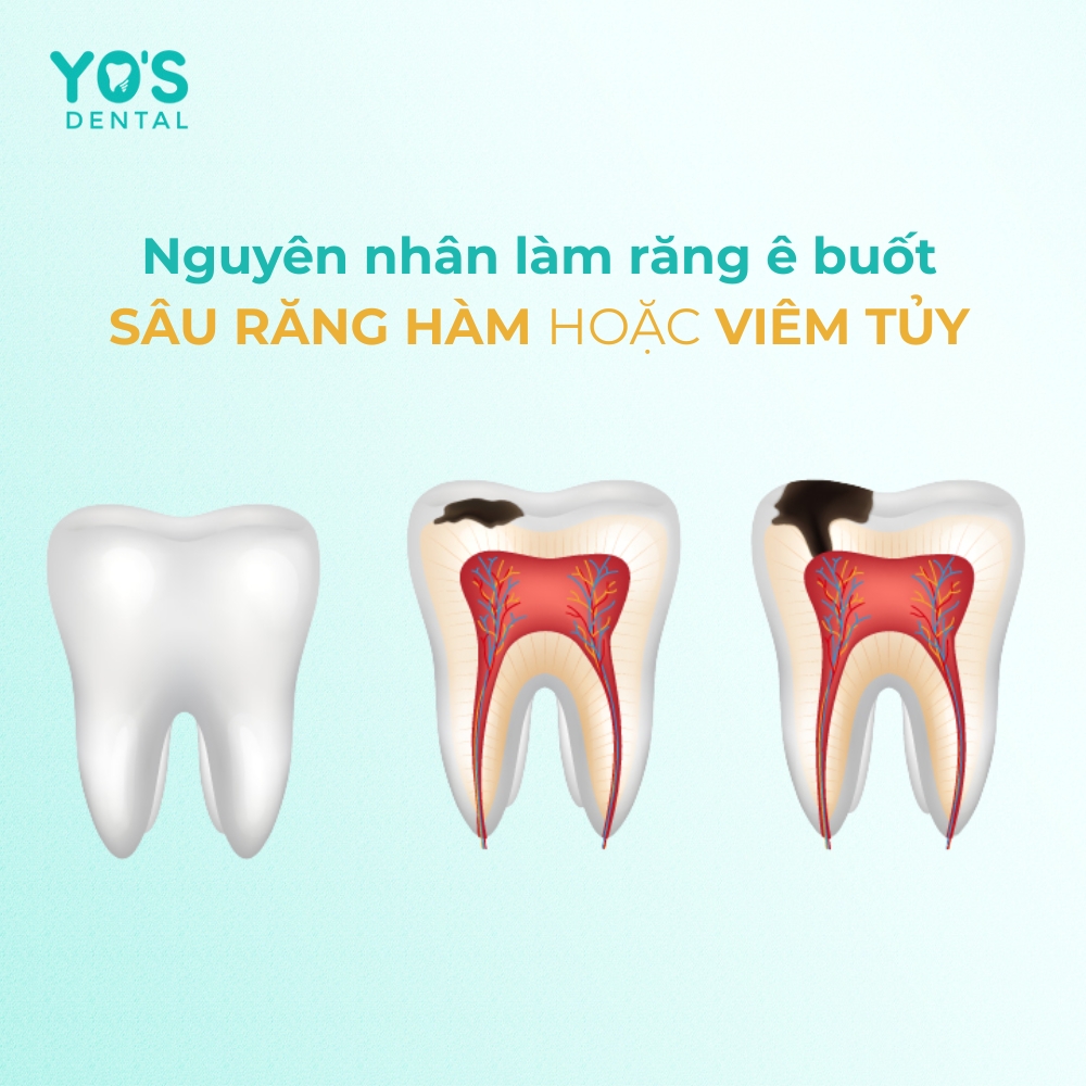 Sâu răng hàm hoặc viêm tủy