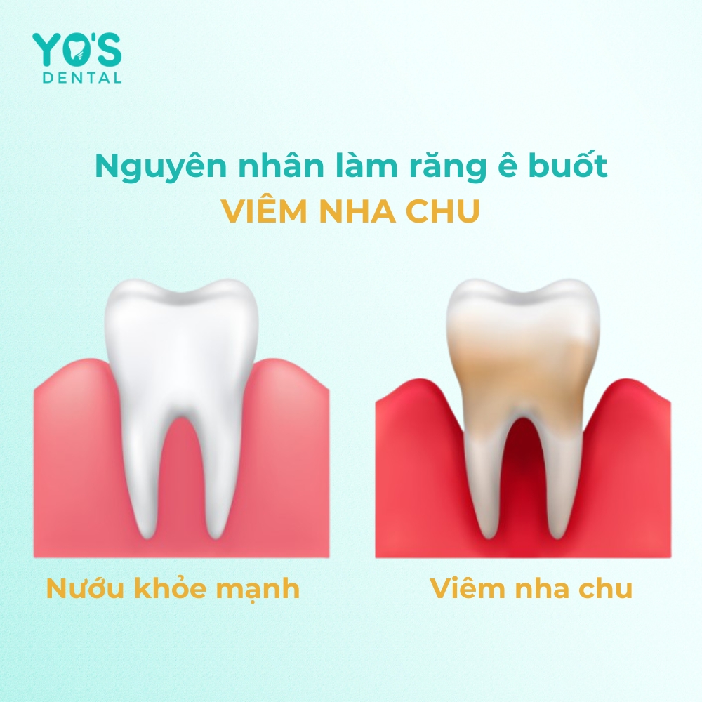 Viêm nha chu