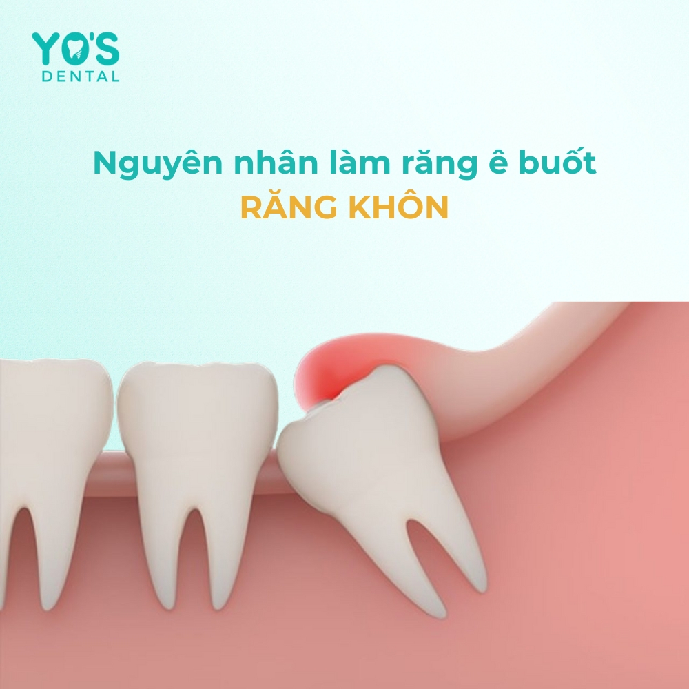 Răng khôn