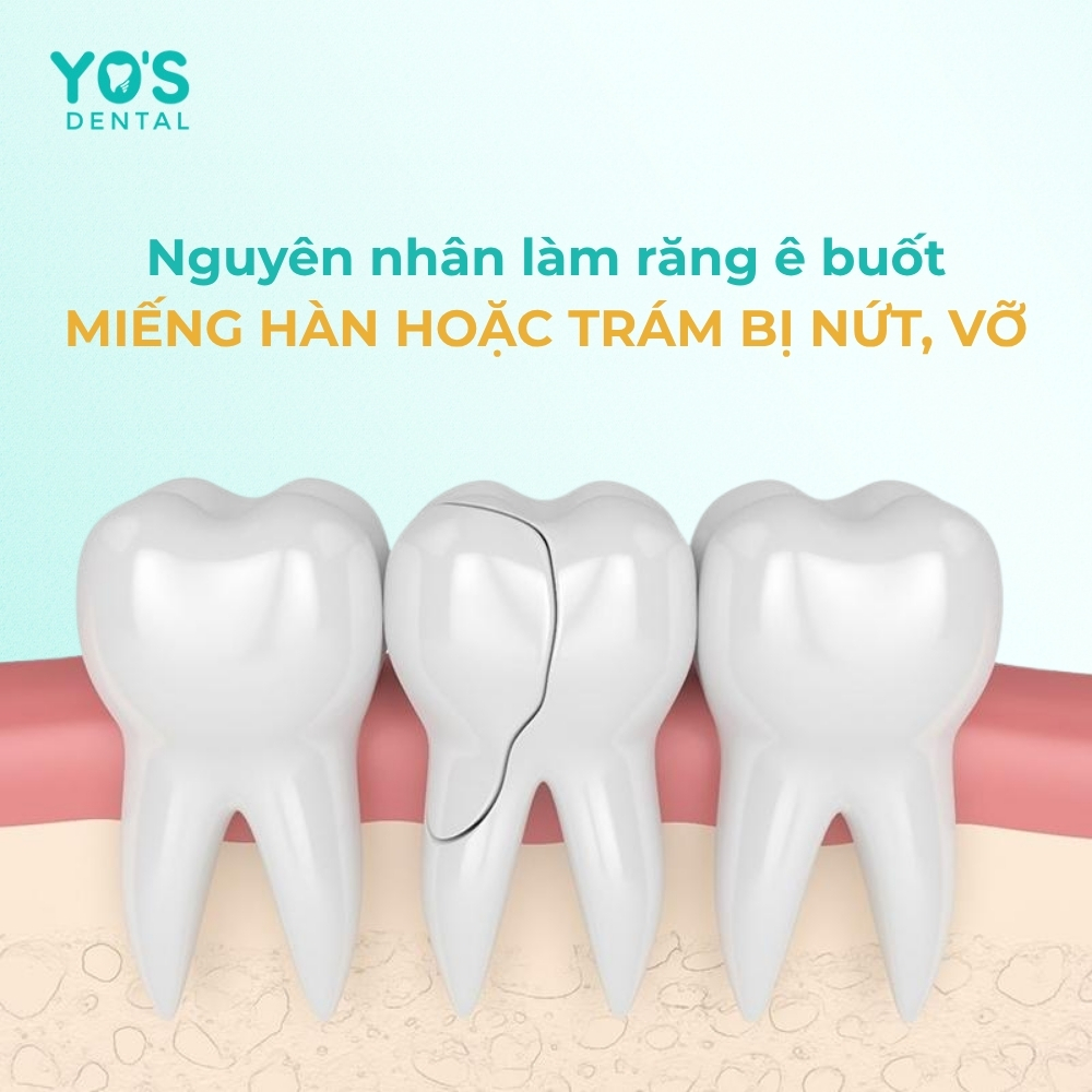 Miếng hàn hoặc trám bị nứt, vỡ