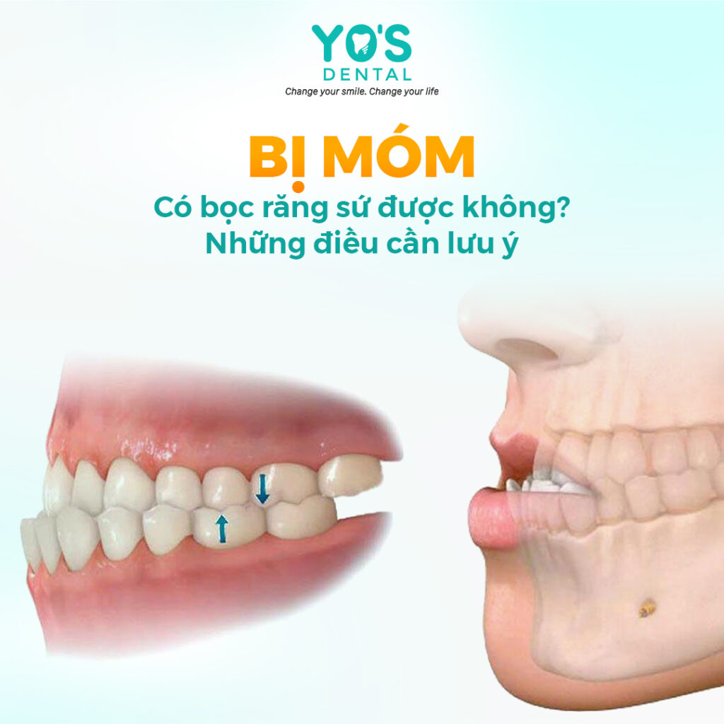 Tìm hiểu tất tần tật về bị móm có bọc sứ được không