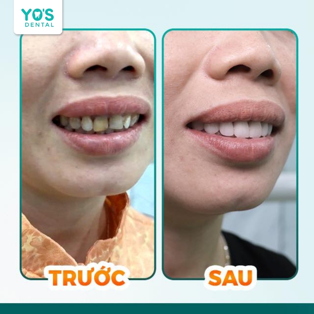 Nụ cười rạng rỡ của khách hàng sau khi bọc răng sứ tại Nha khoa Sài Gòn Bình Dương