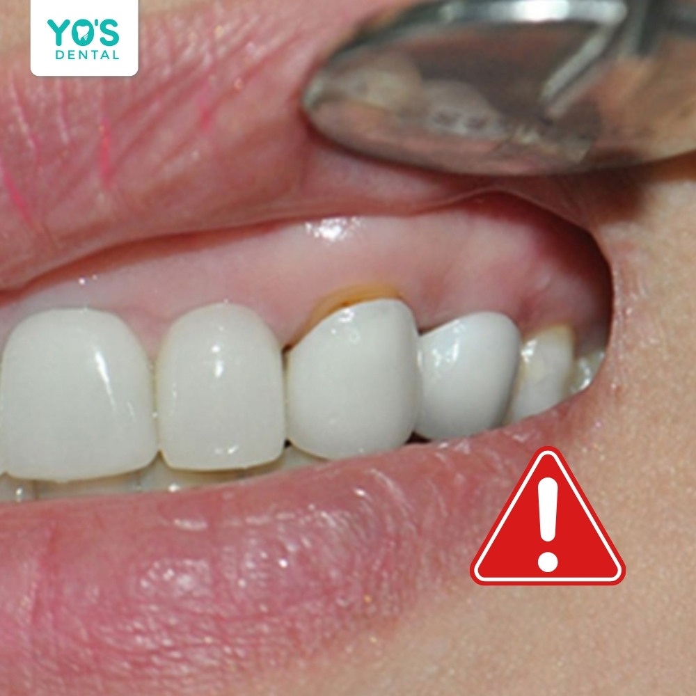 Mão răng sứ bị hở so với đường viền nướu khiến răng bị nhức