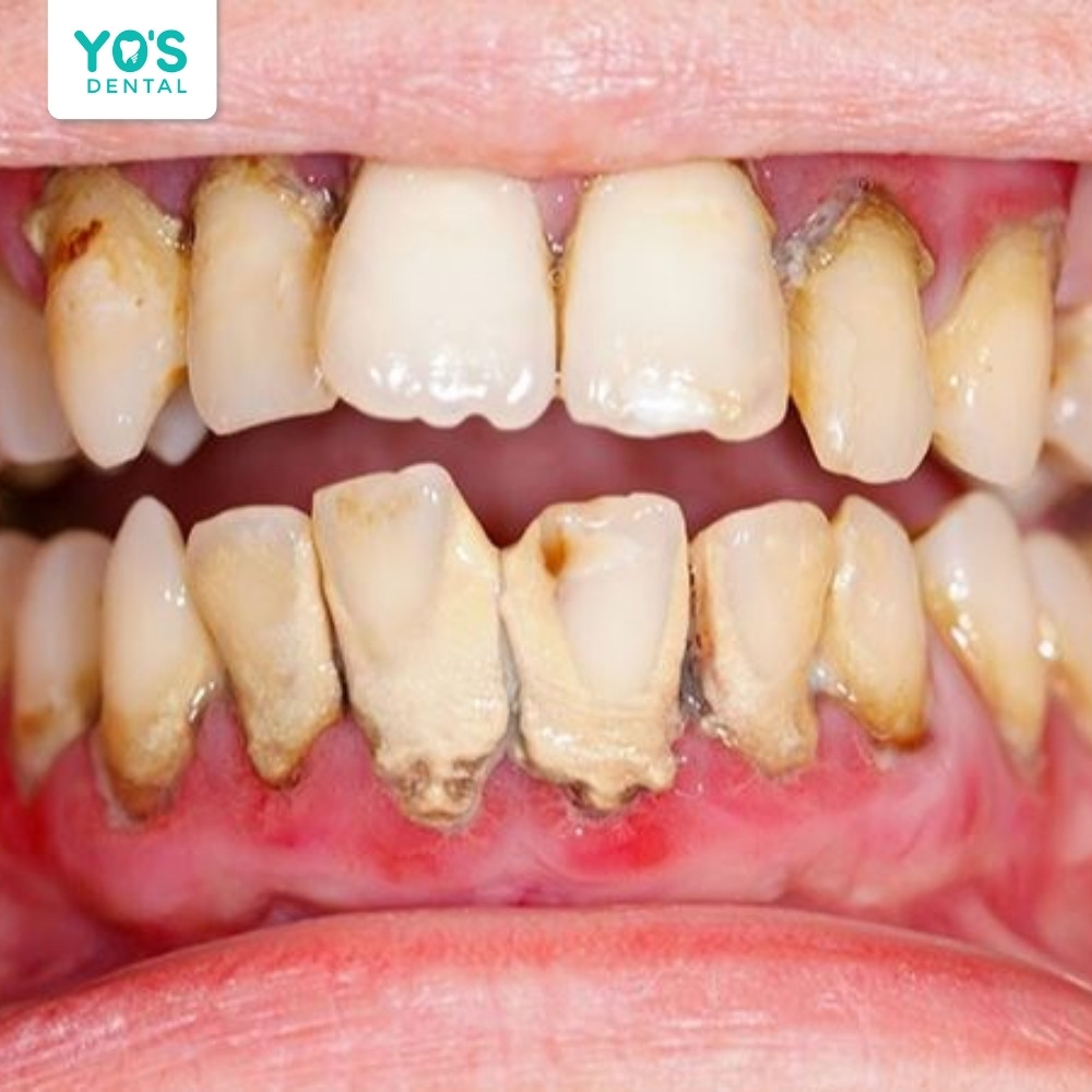 Viêm nha chu kéo dài gây tiêu xương hàm, răng lung lay và đau nhức