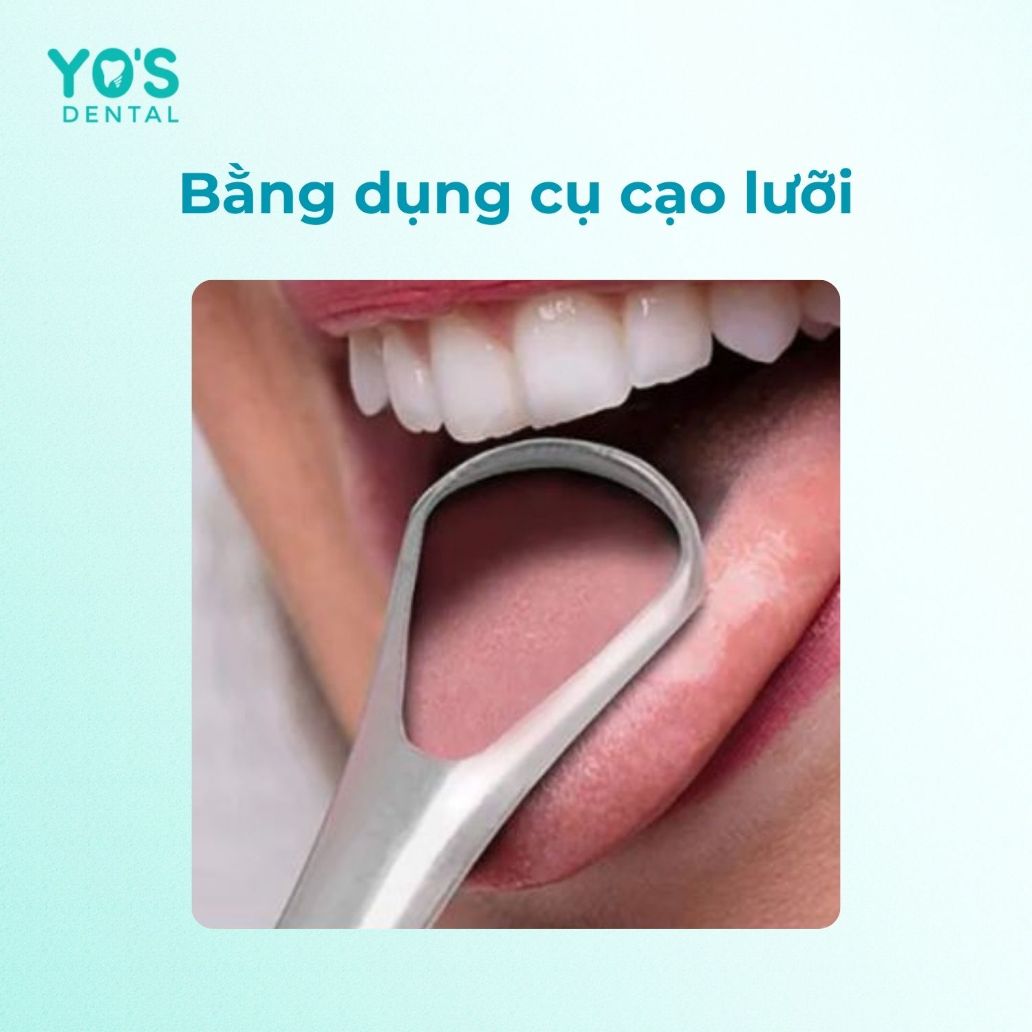 Dụng cụ cạo lưỡi là phương pháp chuyên dụng để làm sạch lưỡi Dụng cụ cạo lưỡi là phương pháp chuyên dụng để làm sạch lưỡi