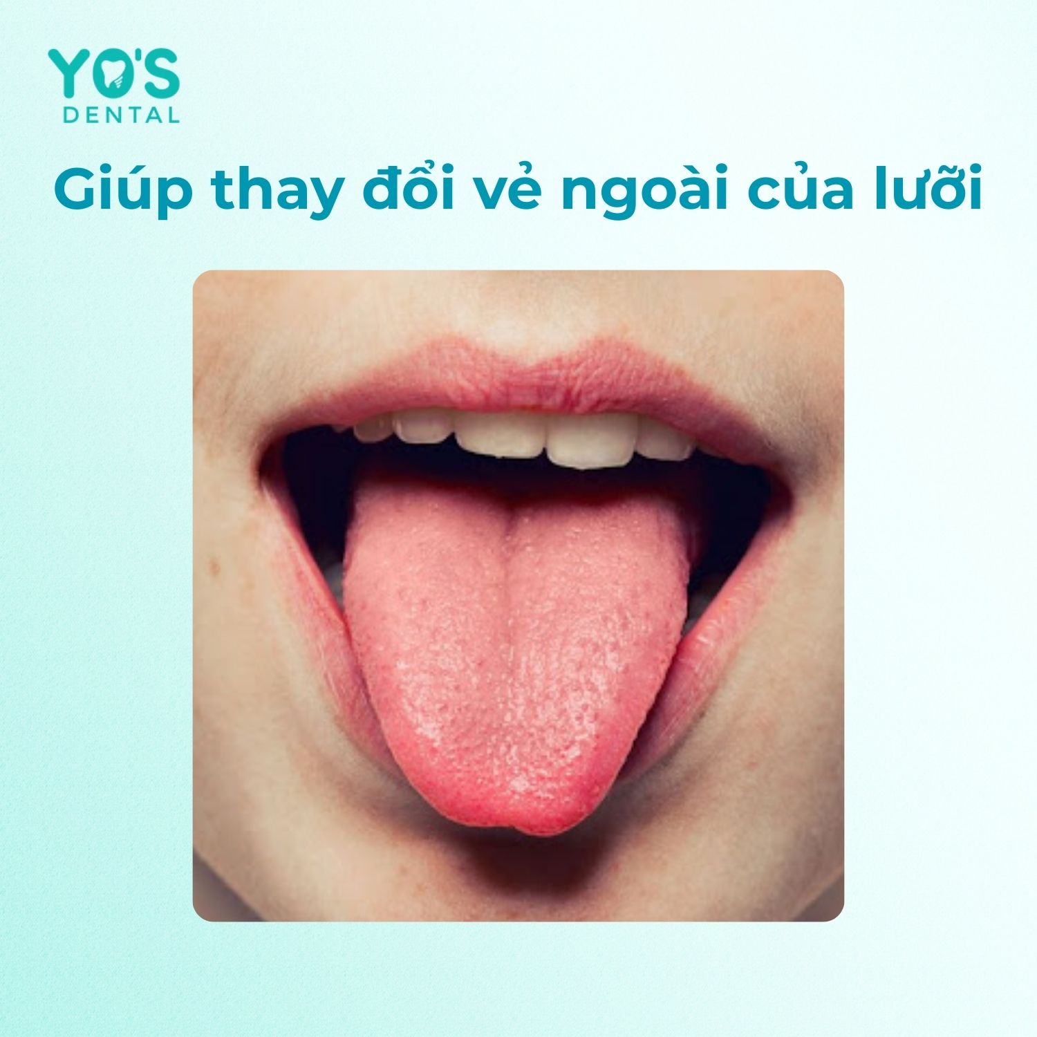 Vệ sinh lưỡi đúng cách giúp lưỡi sạch, đẹp hơn Vệ sinh lưỡi đúng cách giúp lưỡi sạch, đẹp hơn