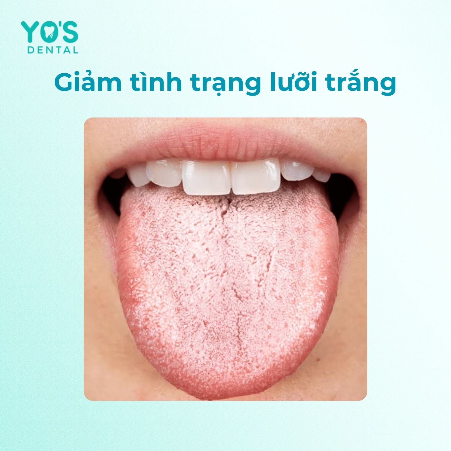 Vệ sinh lưỡi đúng cách giúp giảm tình trạng lưỡi bị trắng Vệ sinh lưỡi đúng cách giúp giảm tình trạng lưỡi bị trắng