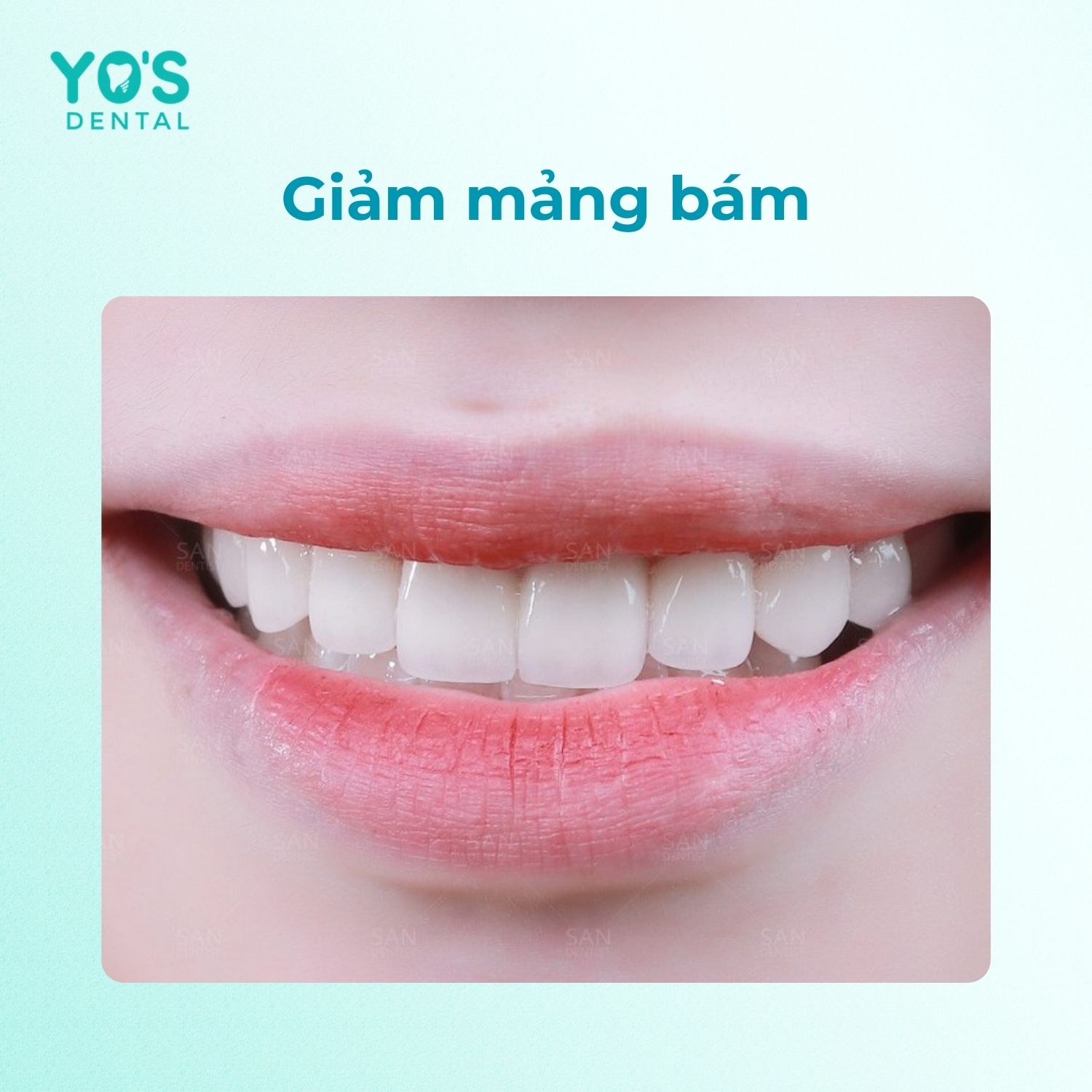 Vệ sinh lưỡi đúng cách giúp giảm mảng bám Vệ sinh lưỡi đúng cách giúp giảm mảng bám