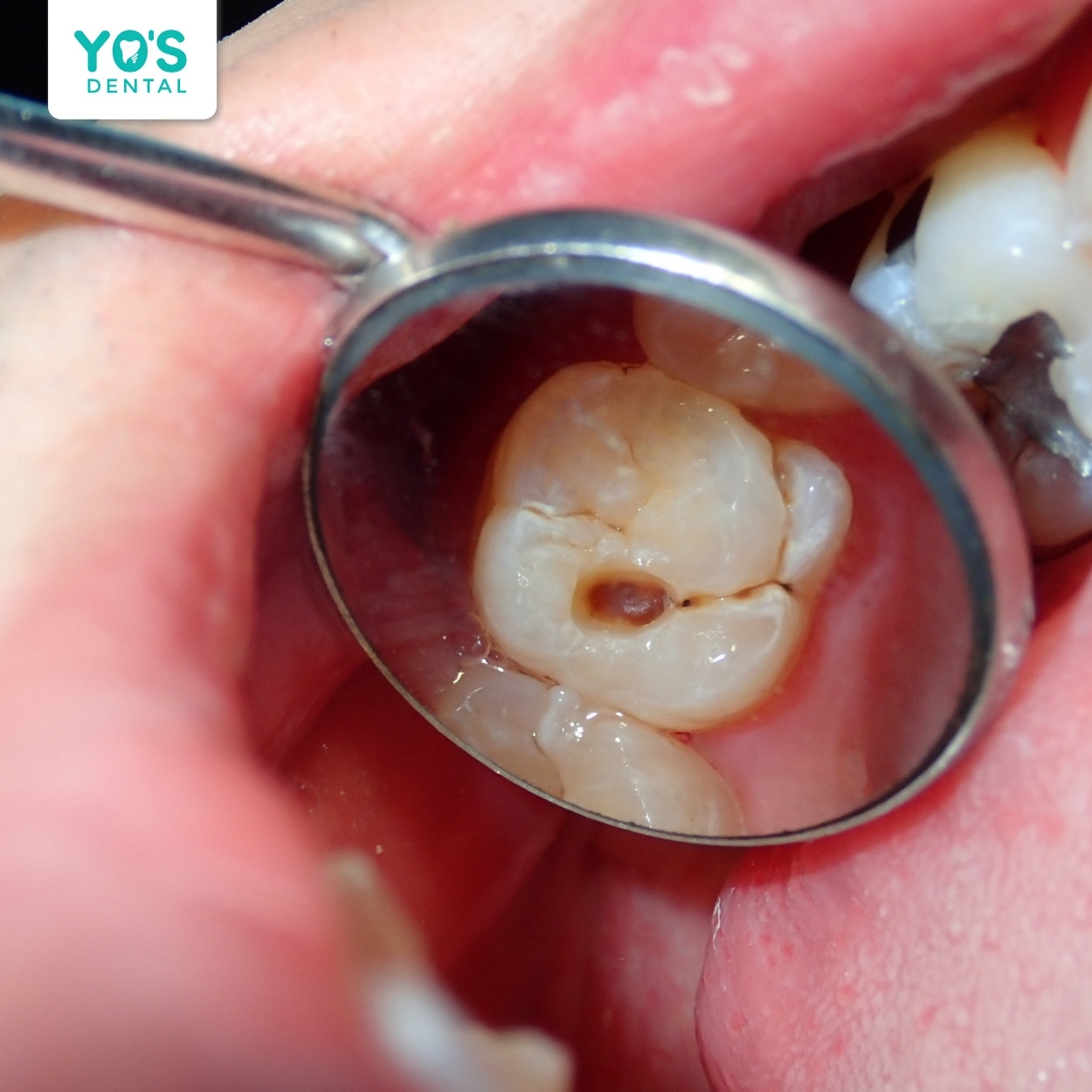 Lỗ sâu trên răng là nguyên nhân chính gây đau nhức.